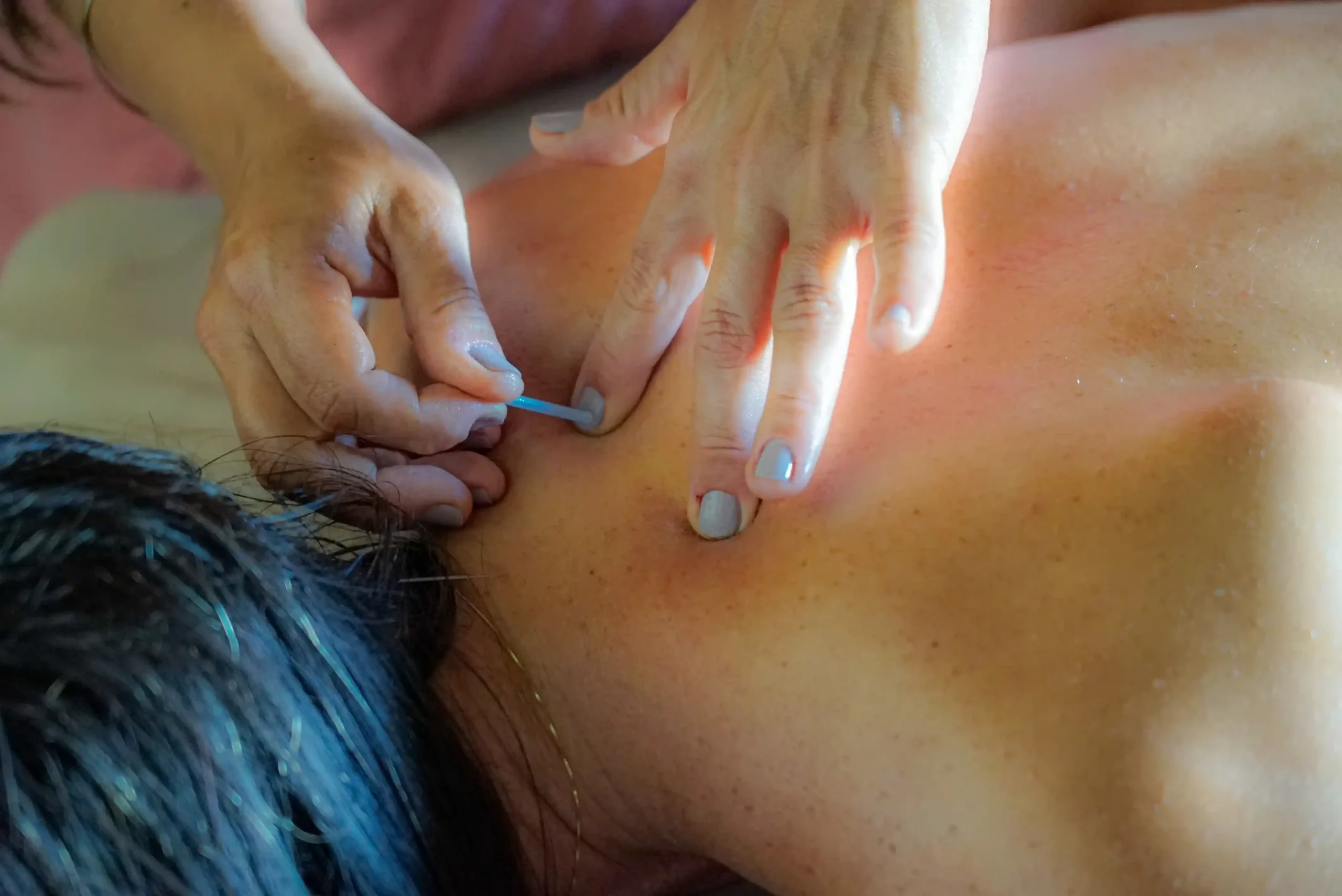 Acupuntura
